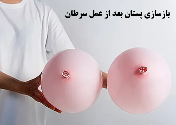 بازسازی پستان بعد از عمل سرطان