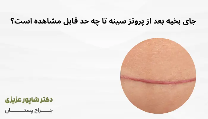 عکس بخیه پروتز سینه جای بخیه بعد از پروتز سینه تا چه حد قابل مشاهده است؟